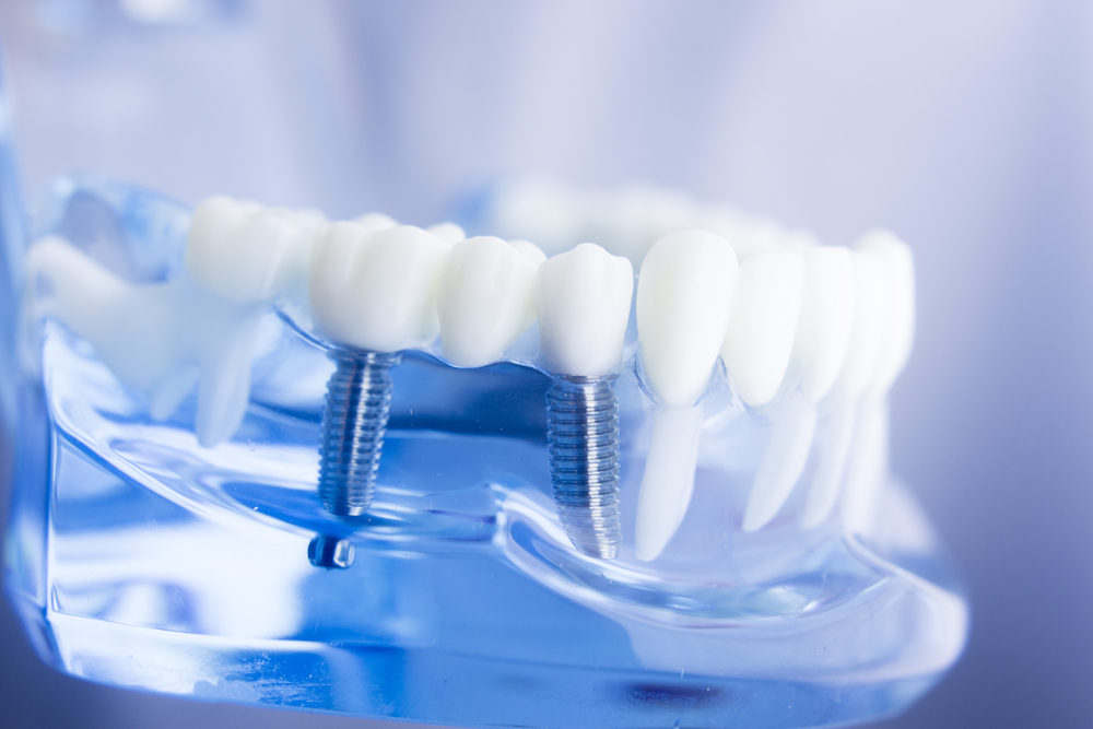 osteointegración de implantes dentales