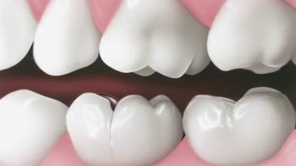 Fisura dental: ¿cuáles son los síntomas y cómo se trata un diente fisurado?