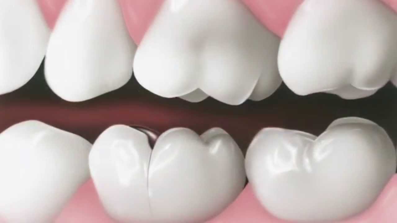fisura dental