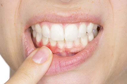 Clínica dental en Pamplona - Tratamientos periodontales