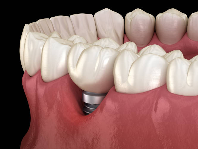 Conservar implantes dentales en Pamplona