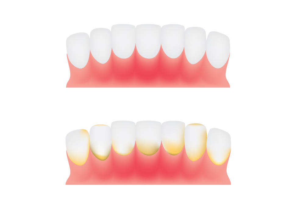 ¿Qué es la placa bacteriana? - Clínica dental Bayona en Pamplona
