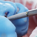 Tecnología 3D al servicio de la colocación de implantes. ¿Qué es la cirugía guiada?